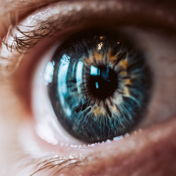 glaucoma_3 glaucoma_3