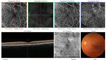 Angiografía (Angio-OCT macular y disco óptico)