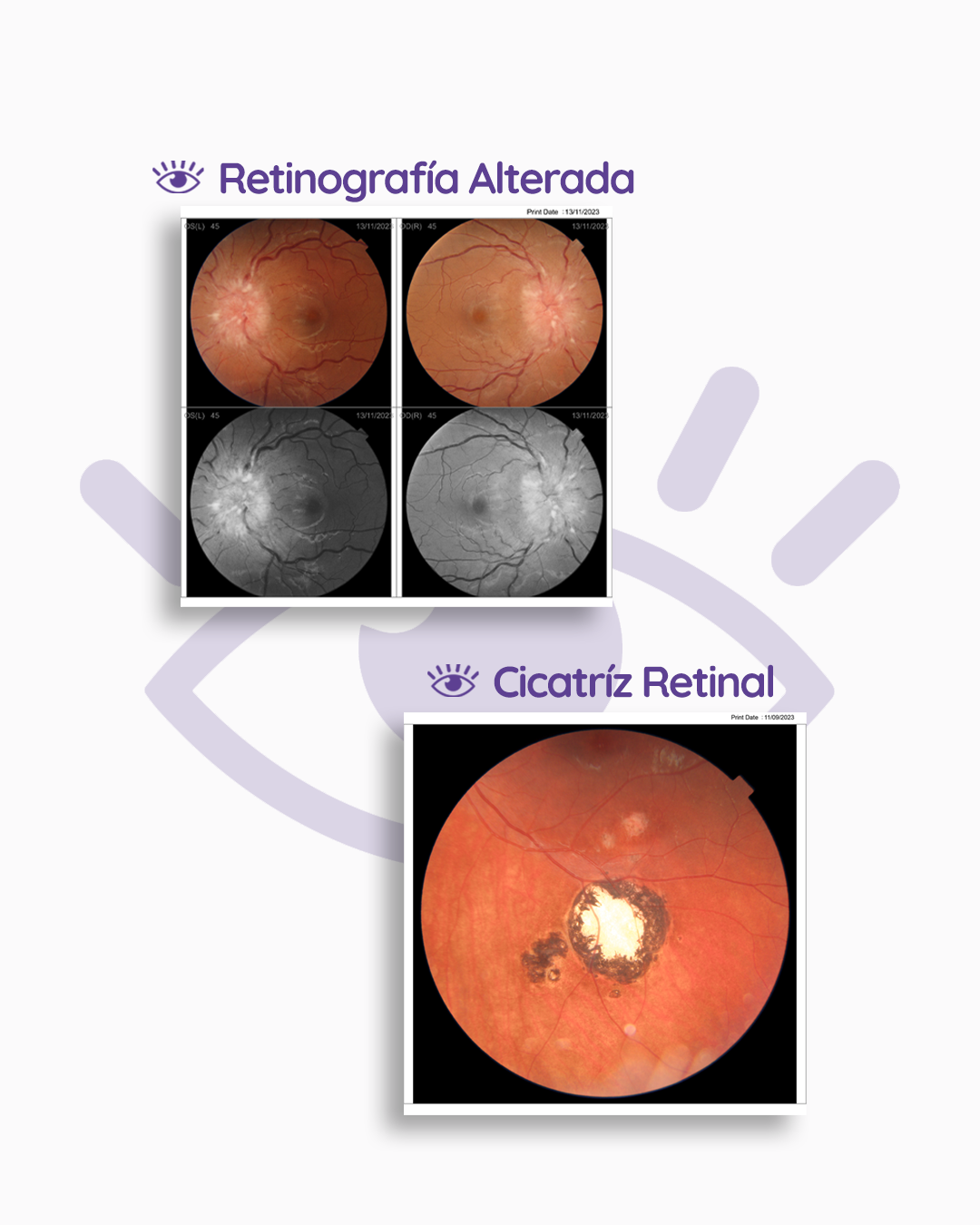 s2_retinografia_feed_1080x1350_03