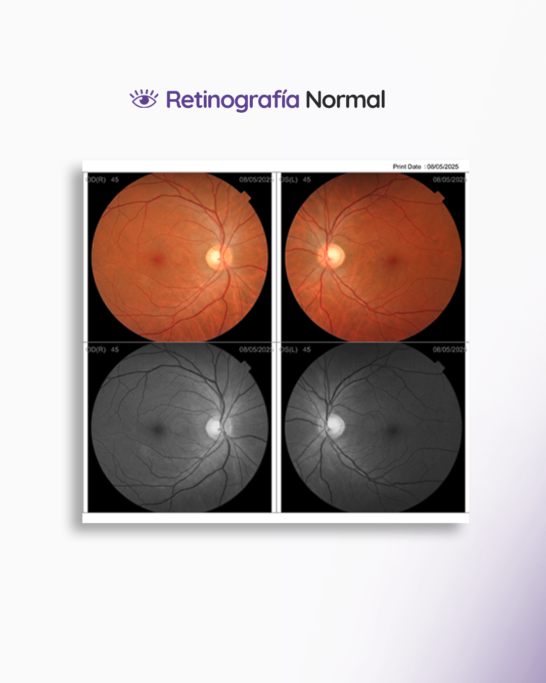 s2_retinografia_feed_1080x1350_04