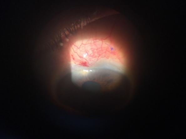 glaucoma-revisioampollasneedling glaucoma-revisioampollasneedling