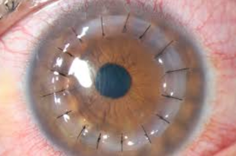 cirugiacorneal cirugiacorneal