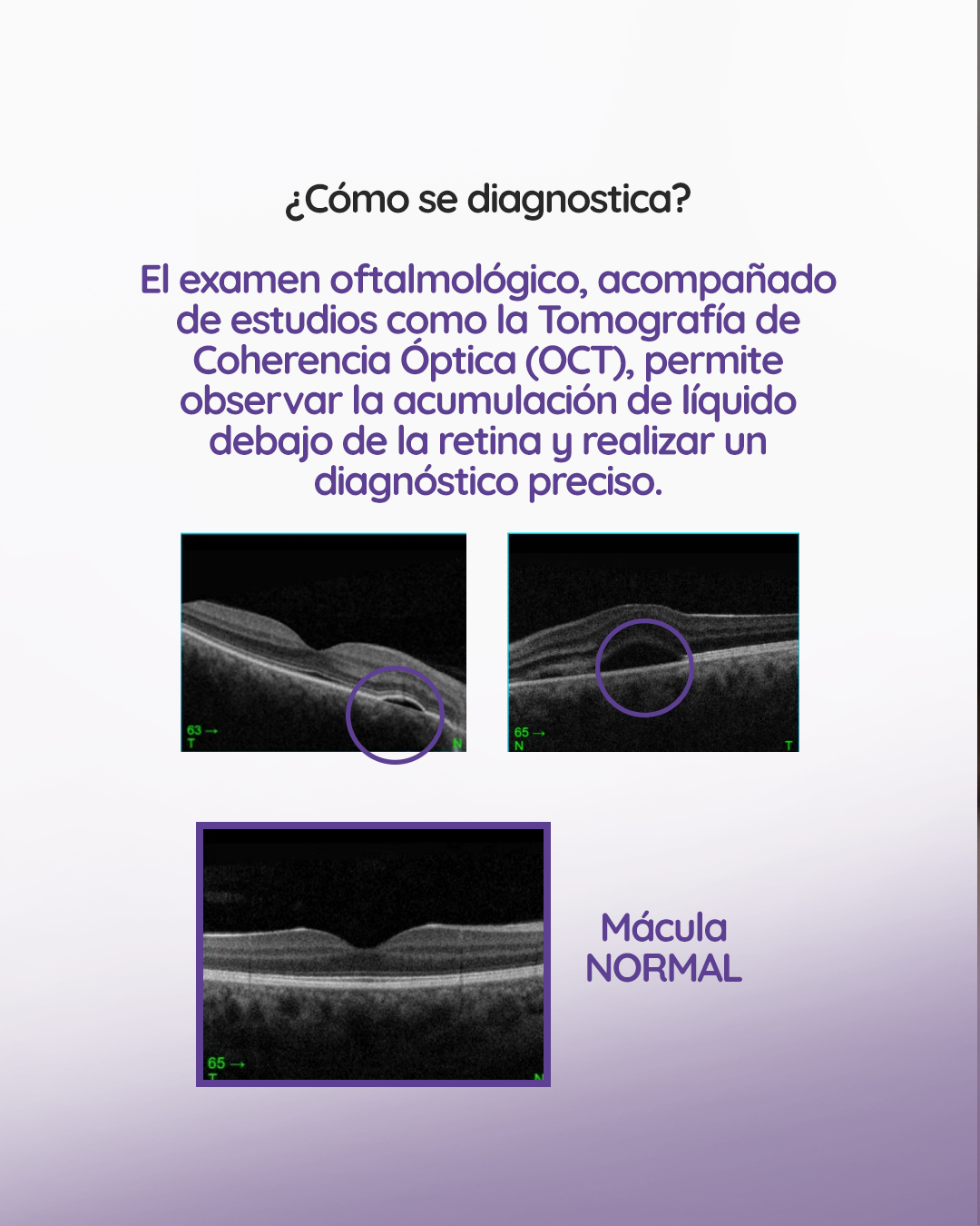 s1_coroidopatiaserosacentral_feed_1080x1350_04