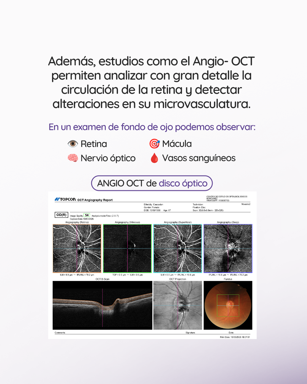 s3_retinavasossanguineos_feed_1080x1350_03