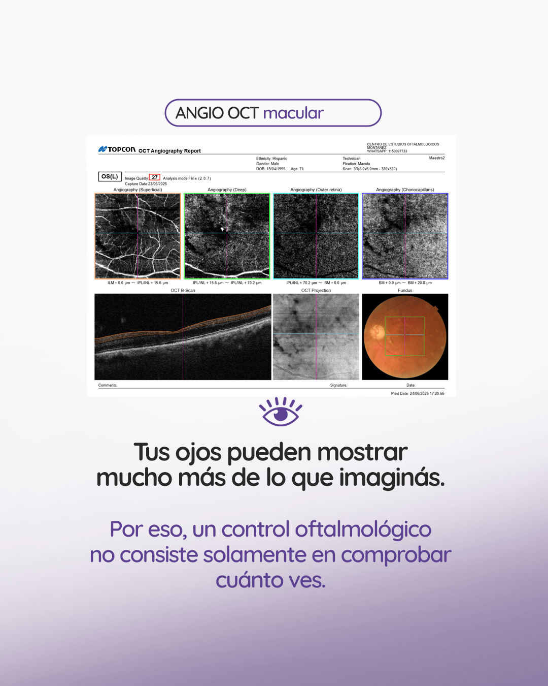 s3_retinavasossanguineos_feed_1080x1350_04