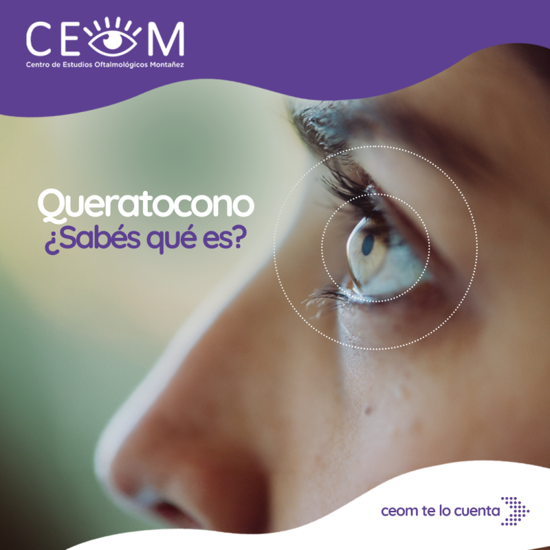 placa_queratocono placa_queratocono