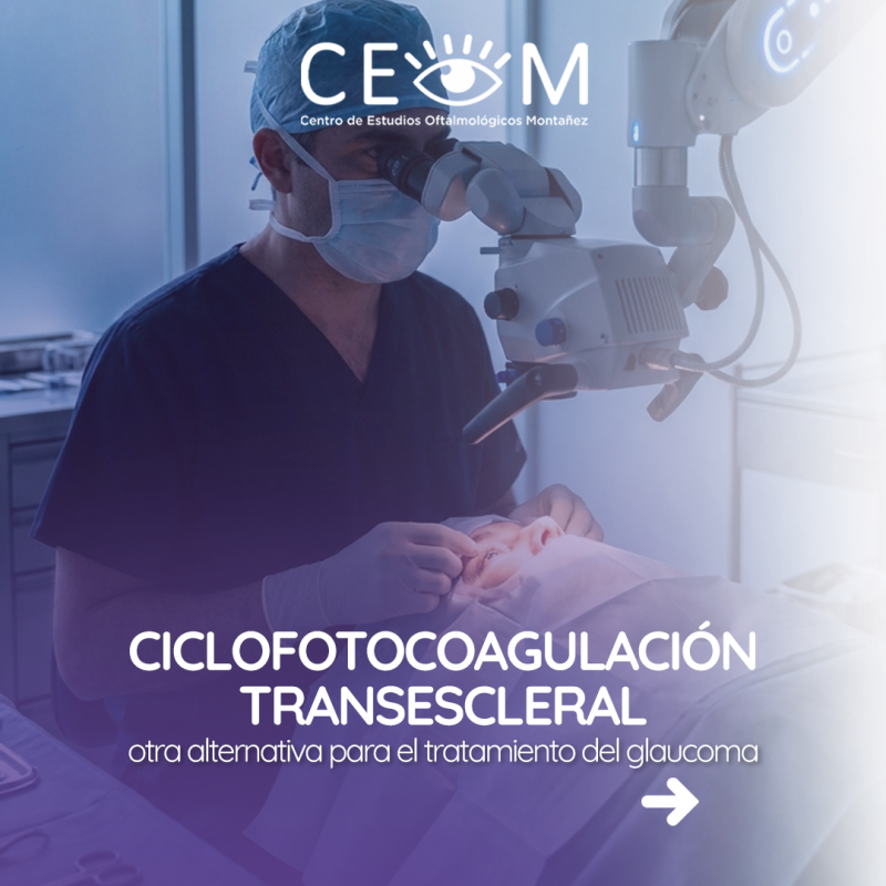 s3_ciclofotocoagulacion-transescleral_feed_1080x1350_01