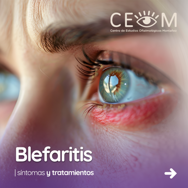 s4_blefaritis_feed_01 s4_blefaritis_feed_01