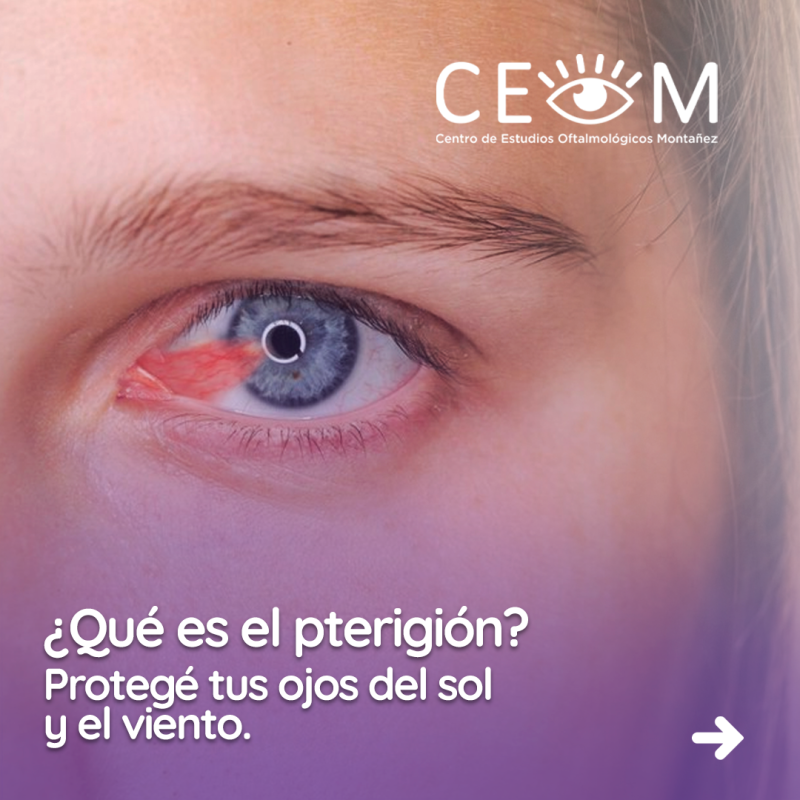 s4_pterigion_feed_01 s4_pterigion_feed_01